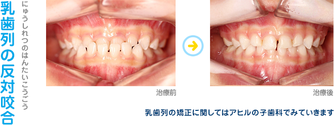 乳歯列の反対咬合（乳歯列の矯正に関してはアヒルの子歯科でみていきます）