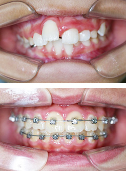 写真：ブラケットをつけることや抜歯だけが矯正治療の手段ではありません。
